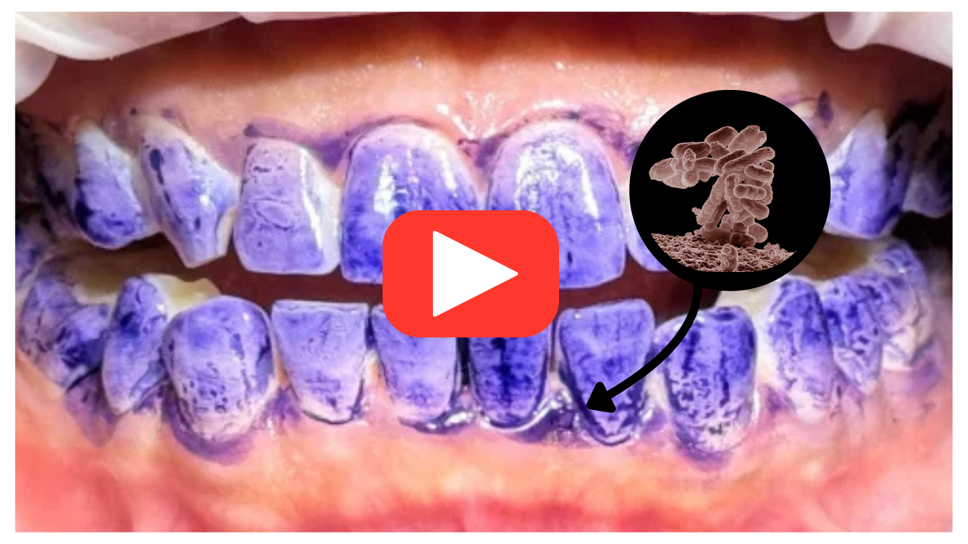 Imagen primeira (Gengiva) BP 02